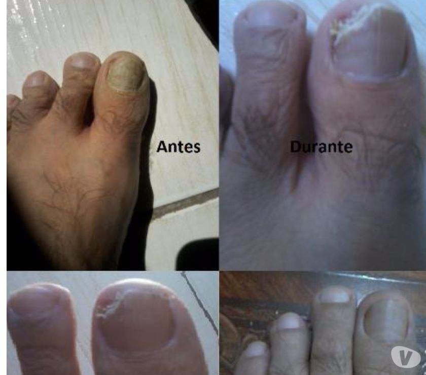 Fungos nas unhas, micose de unha